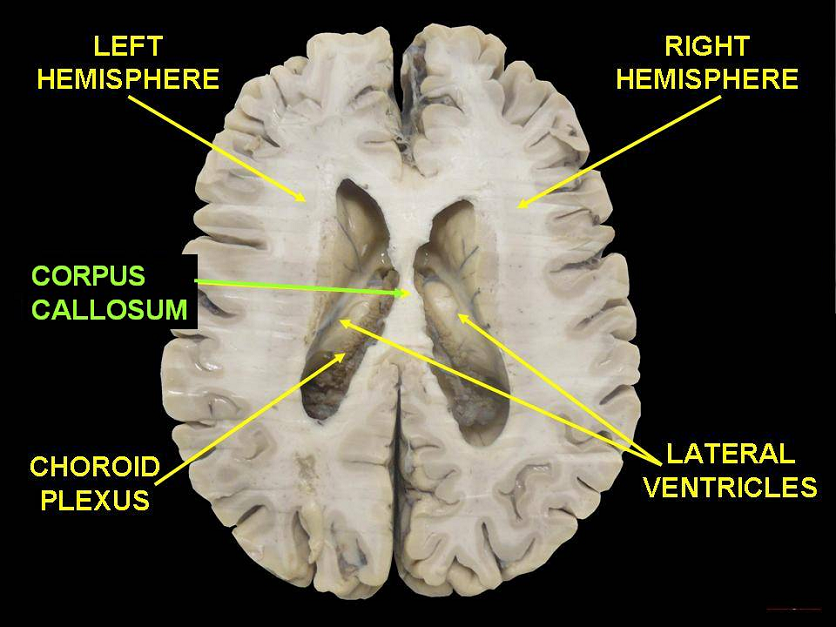 Corpus callosum