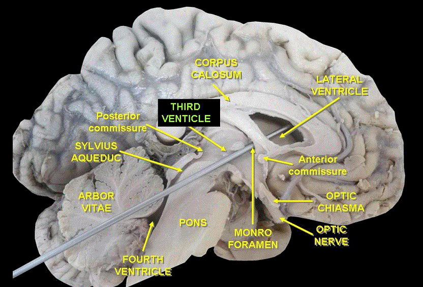 Third ventricle